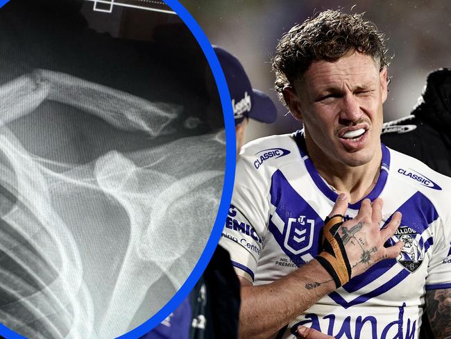 Kurt Mann has broken his collarbone.