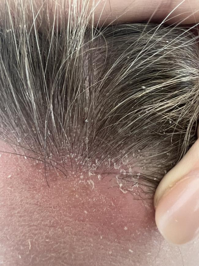 Meagan had a dry, flaky scalp – a skin issue she said is ‘shrouded in shame’. Picture: Supplied