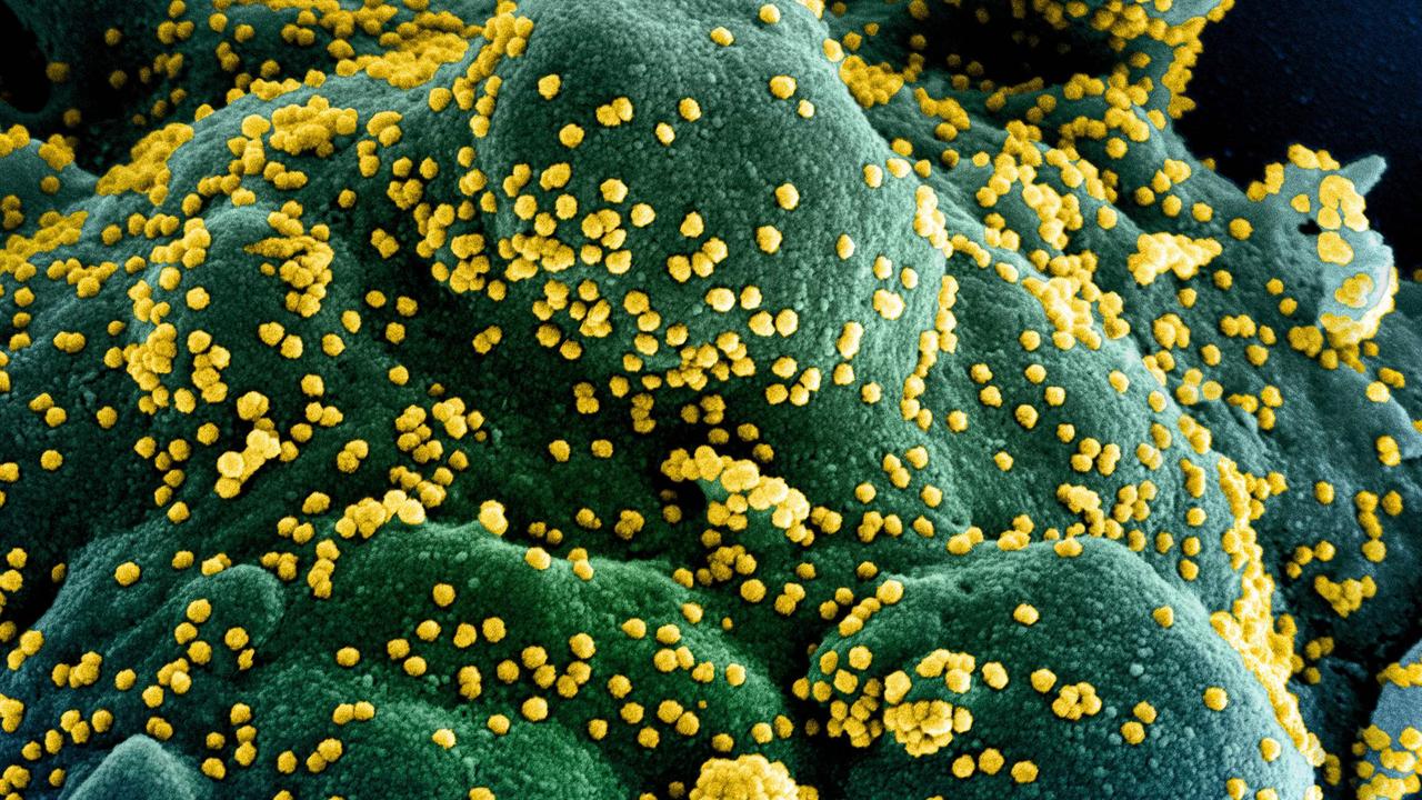 A colorised scanning electron micrograph of an apoptotic cell (blue/green) heavily infected with SARS-COV-2 virus particles (yellow). Picture: National Institute of Allergy and Infectious Diseases / AFP