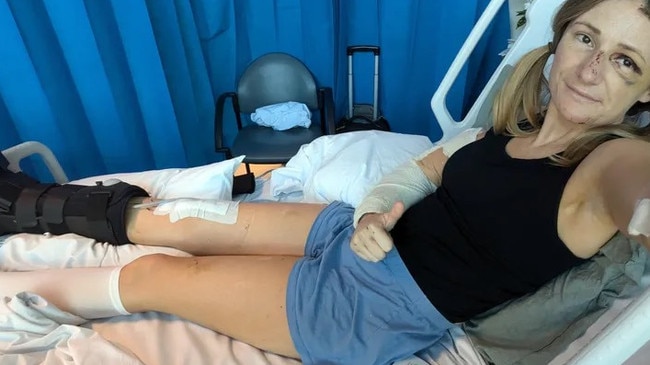 Bridget Harvey seriously injured her leg after her moped crashed into a bus on Magnetic Island on June 7. Picture: GoFundMe