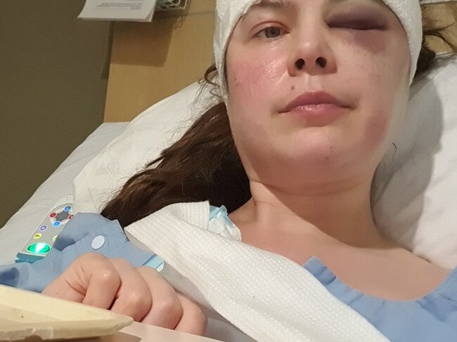 Mrs Bolonina shares an image of herself after surgery to remove a brain tumour in April.