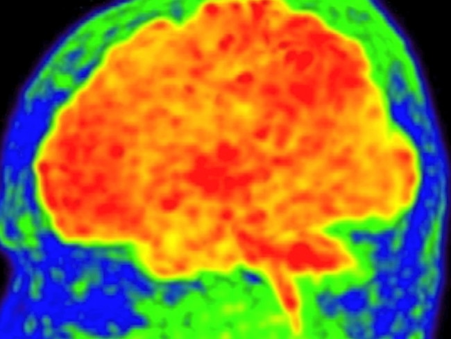 These scans show amyloid beta plaque build up in the brain. Credit: Rob Williams