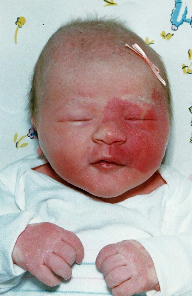 Newborn Crystal — between birth and 11 she had around 30 surgeries.