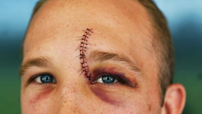 South Sydney Rabbitohs Jason Clark shows off his stitches. Picture. Phil Hillyard