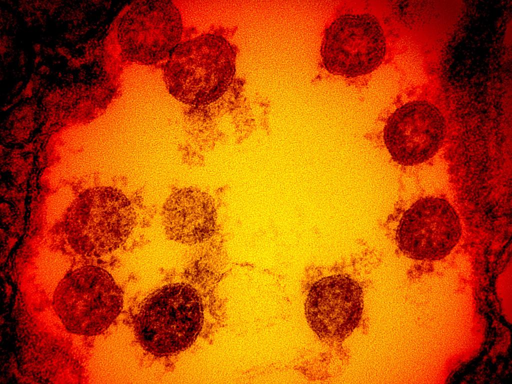 A transmission electron micrograph of SARS-CoV-2 virus particles, isolated from a patient.