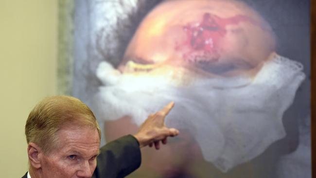 Democrat Senator Bill Nelson points to the injury on a victim who was hit by shrapnel when a car's Takata airbag inflated. Picture: AP.