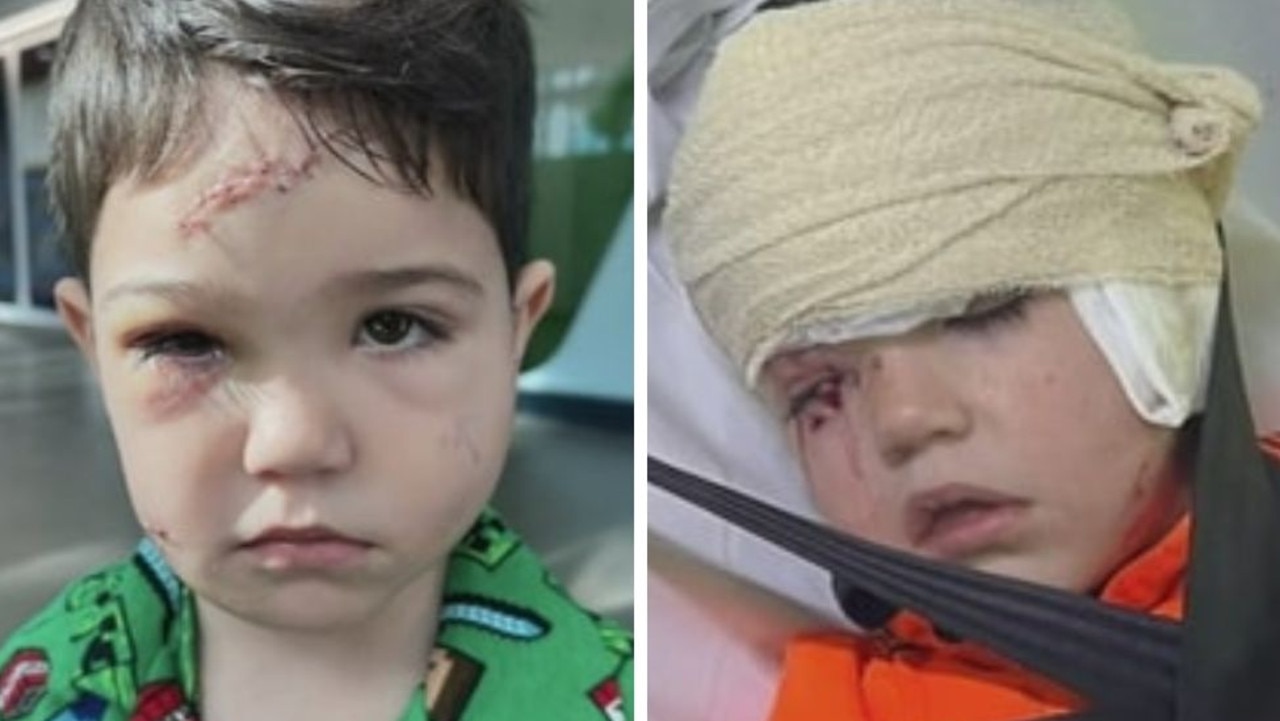 Boy’s face split open in horror dog attack