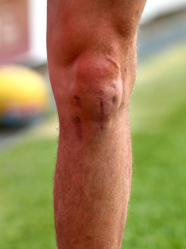 His battle-scarred knee. Picture: Gregg Porteous