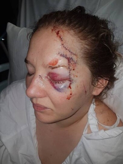Lacey Davison and her injuries after the glassing attack. Supplied.