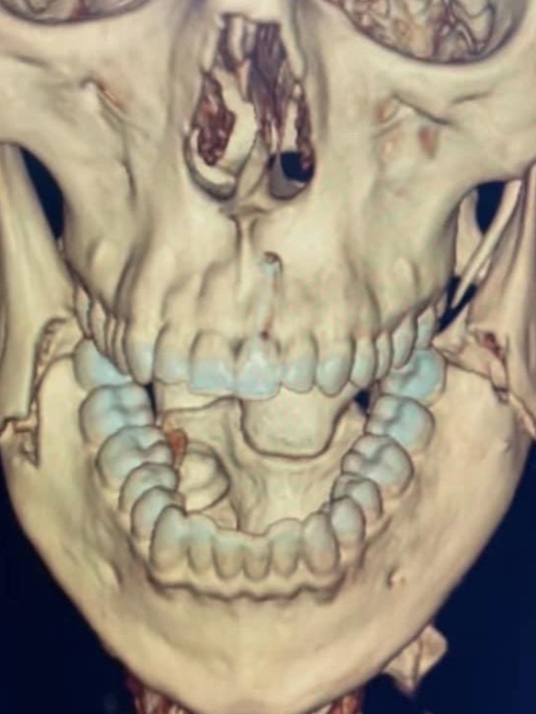 Jai Opetaia suffred a double fracture of the jaw.