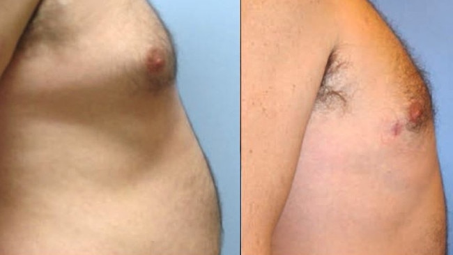 Before and after in a breast reduction procedure. 