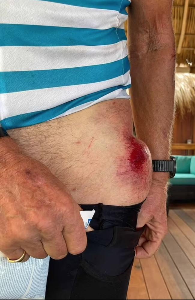 Sir Richard Branson's injuries from his recent bike crash. Picture: Instagram