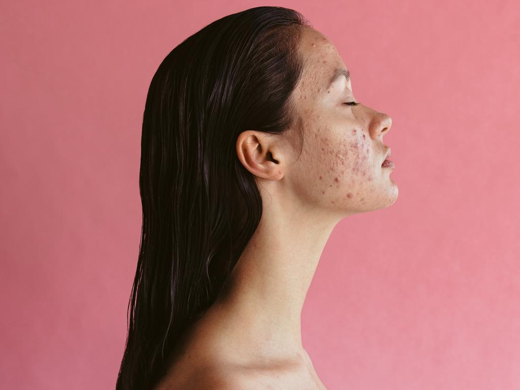 Side view portrait of woman with acne inflammation on pink background. Skin disorders lead to depression and insecurities in women.