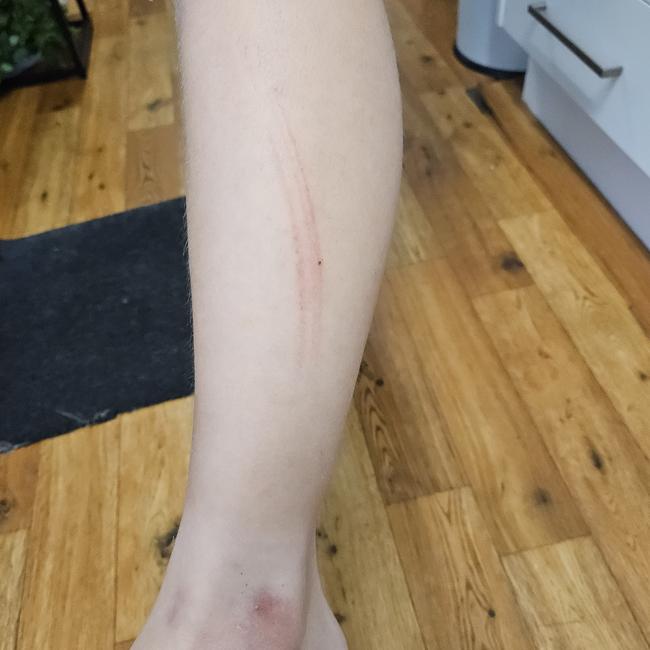 Scratches down the boy’s leg after he was allegedly attacked with a pair of scissors. Picture: Supplied