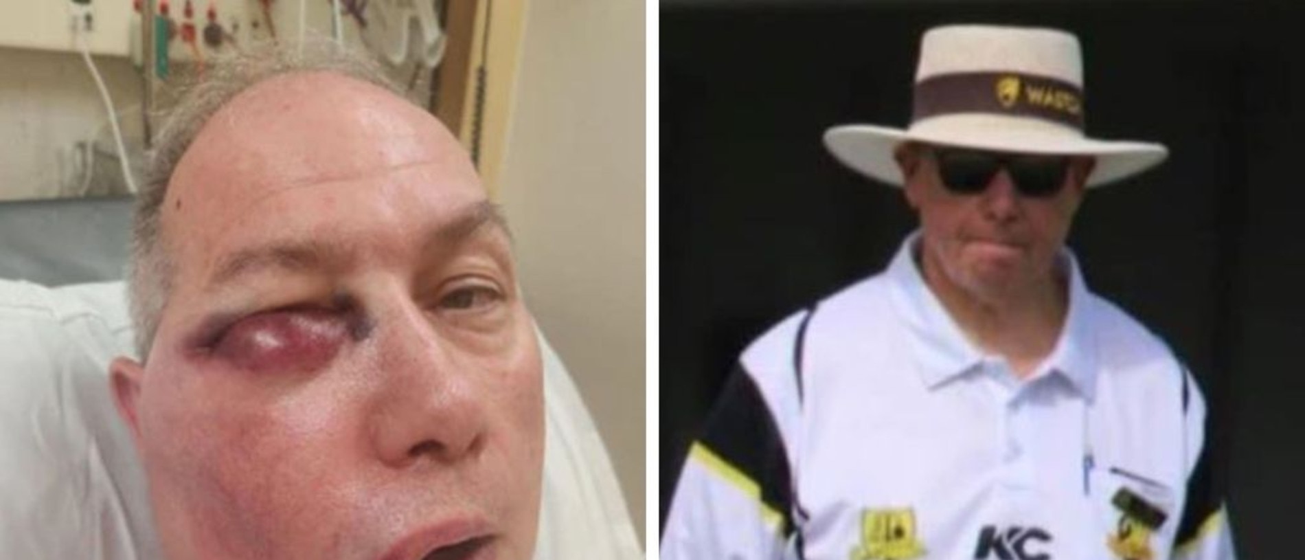 Cricket umpire reveals horror injuries after being hit in the face with ball