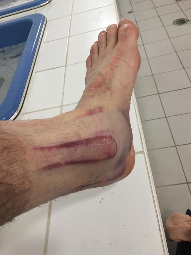 Easton Wood's ankle after the Round 22 game against Essendon.