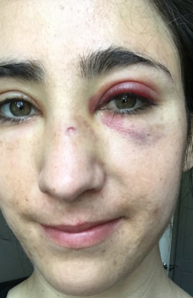 In addition to numerous facial cuts and bruises, Ms Geymonat suffered black eye and Ms Hannigan a broken jaw in the May 30 attack. Picture: Supplied