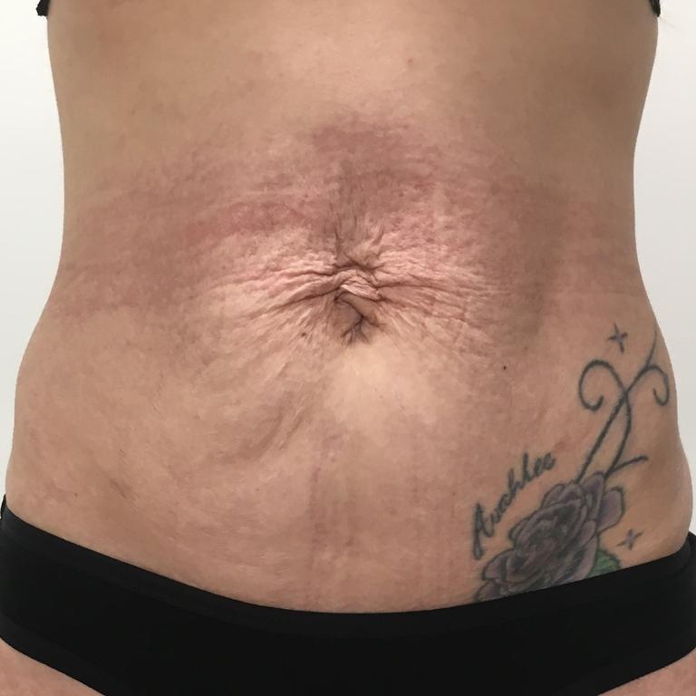 Elona Henderson: Before Emsculpt treatment, May 13 2019. Picture: Supplied.