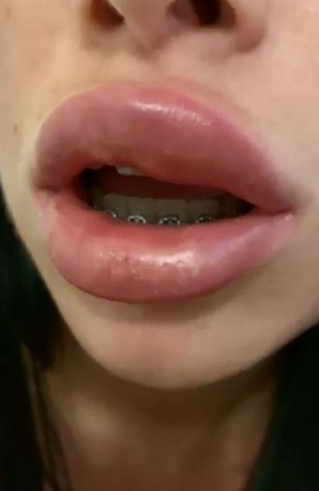 The 24-year-old told A Current Affair the procedure had gone wrong, leaving her with swollen lips and in severe pain. Picture: Channel 9