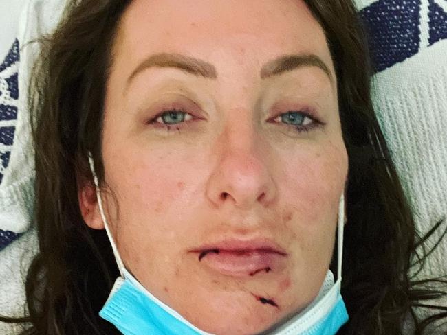 Gogglebox star’s horror Christmas injury