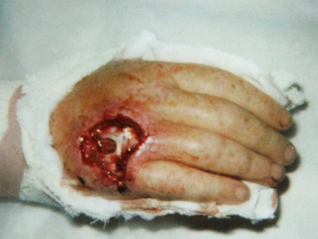 Kingscliff man Greg Burton suffered from a flesh eating bacteria earlier this year called photorhabdus. He believes he came into contact with the bacteria while digging holes in his backyard. Copy picturs of surgical photos. Reporter: Trevor Paddenburg