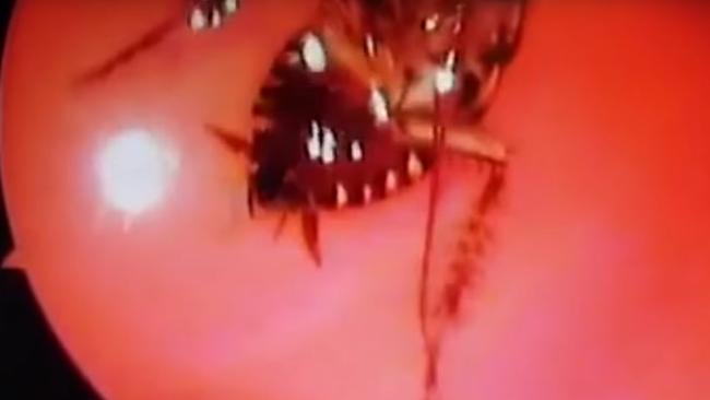 Doctors removed a live cockroach from an Indian woman's skull.