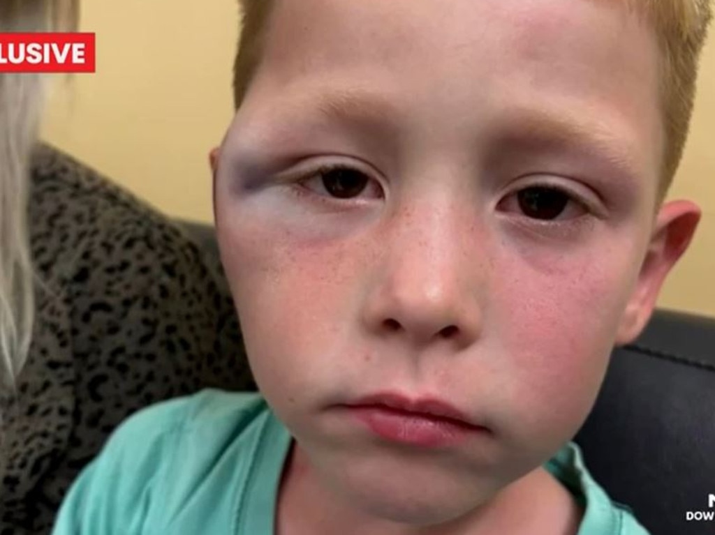 The parents of a five-year-old boy in NSW have called for action after their son was allegedly brutally attacked with a golf club by another kid. Picture: 7NEWS