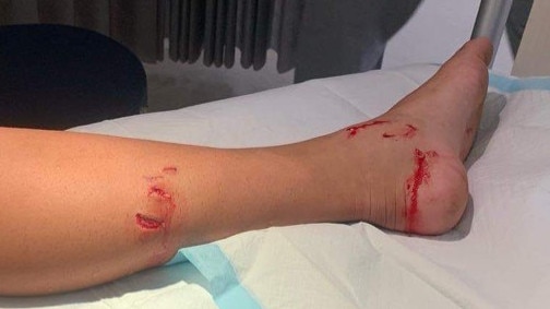 Tim McAndrew was bitten on the leg by a shark in chest-deep water at Crowdy Beach. Picture: Supplied