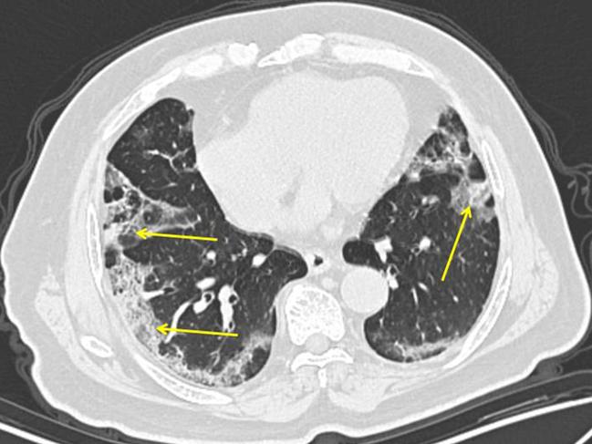 This image provided by Mount Sinai Hospital in March shows a CT scan from a 65-year-old man in China with COVID-19. Pneumonia caused by the new coronavirus can show up as distinctive hazy patches on the outer edges of the lungs, indicated by arrows. Picture via AP