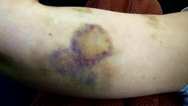 Just one of Kimbarlie’s bruises after being bashed and dragged by Jake Frecker. Picture: Supplied