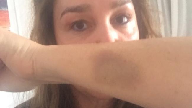 Kate Langbroek with the bruise she suffered after the March 2 attack. Picture: Twitter