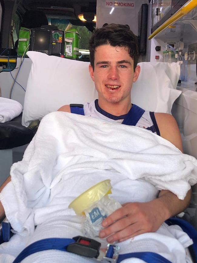 Andrew Brayshaw has a broken jaw and displaced teeth. Source: Instagram