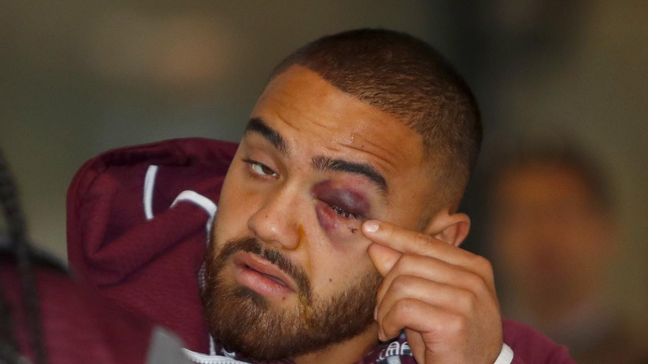 Dylan Walker of the Sea Eagles sports a black eye after being punched by Curtis Scott.