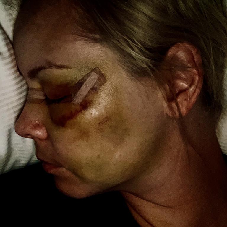 Kimbarlie O’Reilly was left with horrific injuries.