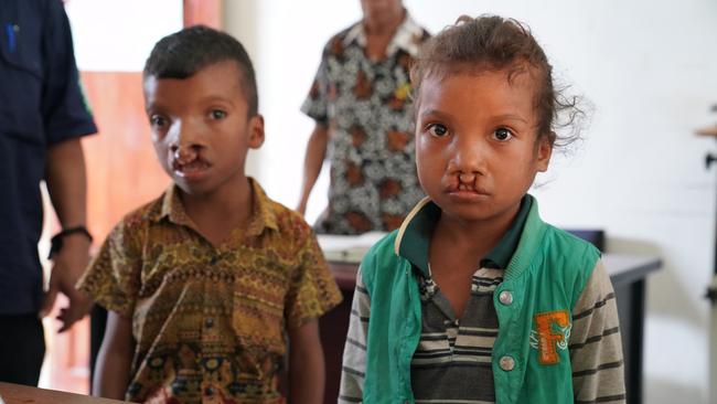 The siblings suffering from cleft palates. Picture: Zameer Gill