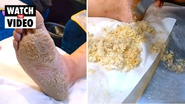 Gross moment beautician shaves off mountains of dry skin on client's feet, video