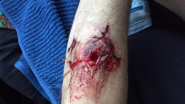 A 63-year-old North Lakes needed surgery after being attacked by three large dogs in Burpengary earlier this year.