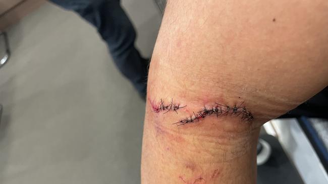 And the resulting 37 stitches. Picture: Supplied