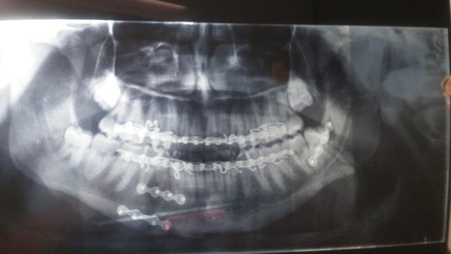 X-ray of Ryan Holman's badly broken jaw showing the metal screws and wires he's had inserted after he was assaulted by Iliesa Cama. Picture: Facebook