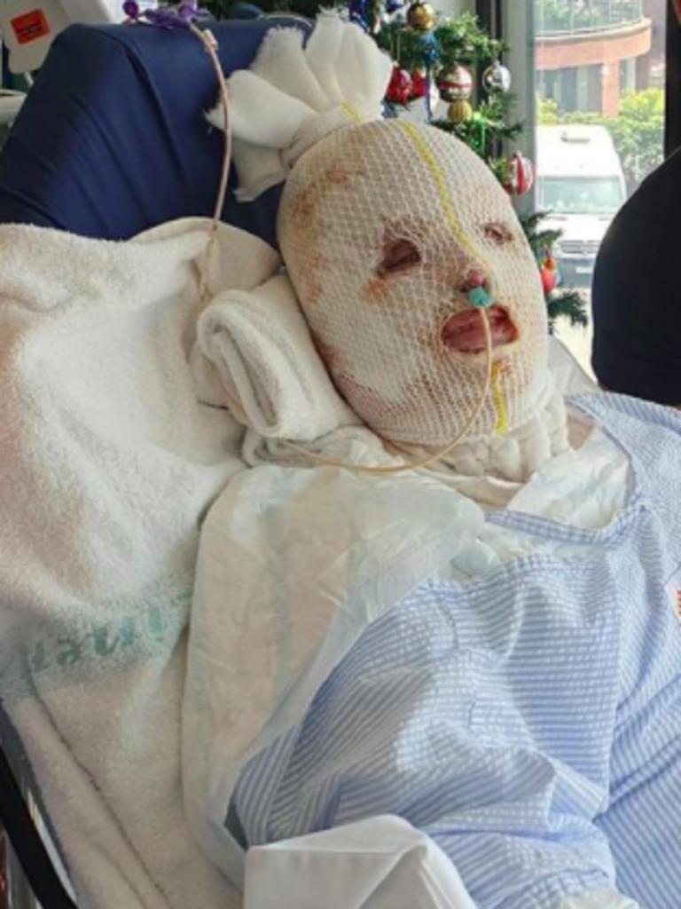 She suffered burns to 70 per cent of her body. Picture: Instagram