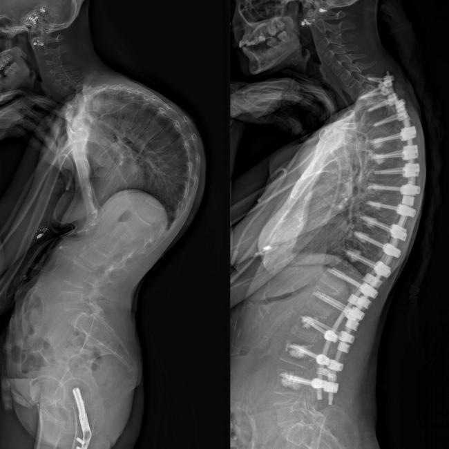 Annaliese Holland’s before and after life saving spinal surgery from the side. Picture: Supplied