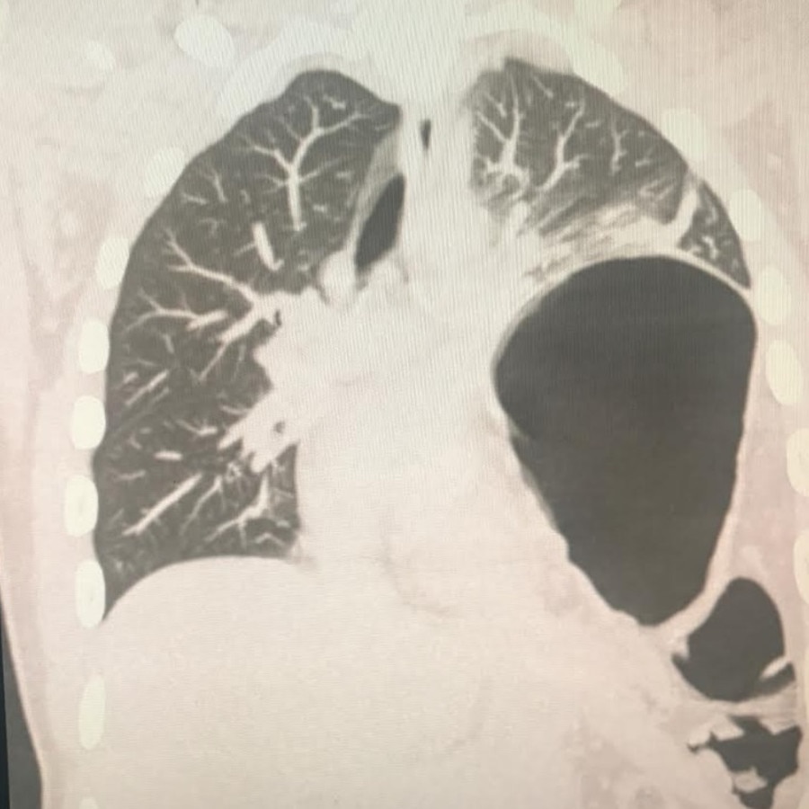 It later caused his stomach organs to herniated into his chest, collapsing his left lung (pictured). Picture: Jacob Pearce