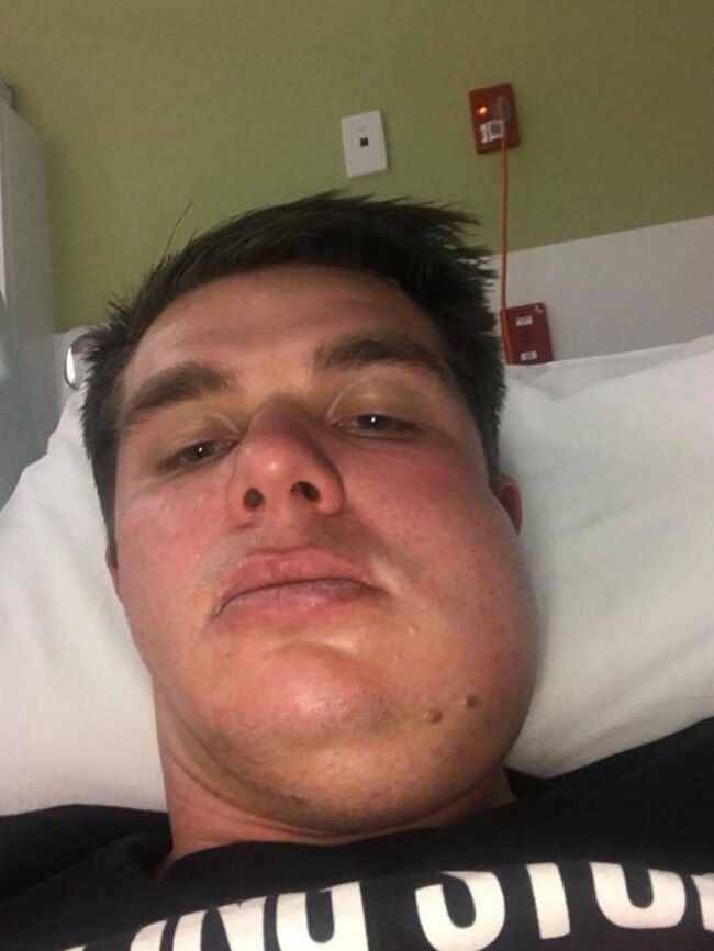 Carl Teusner underwent surgery on Wednesday for his broken jaw. Supplied.