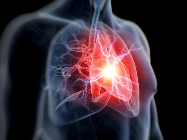 GPs may recommend a specialised CT scan looking for plaque blocking the coronary arteries. Picture: Getty Images