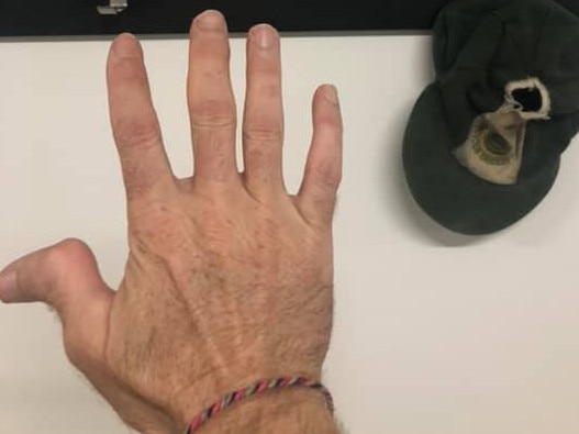 Brent 'Rexy' Kremer right thumb.