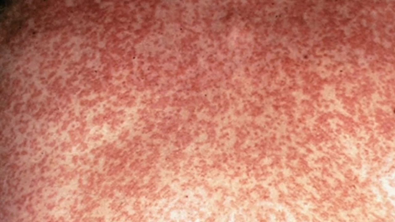 A measles rash. Picture: Supplied