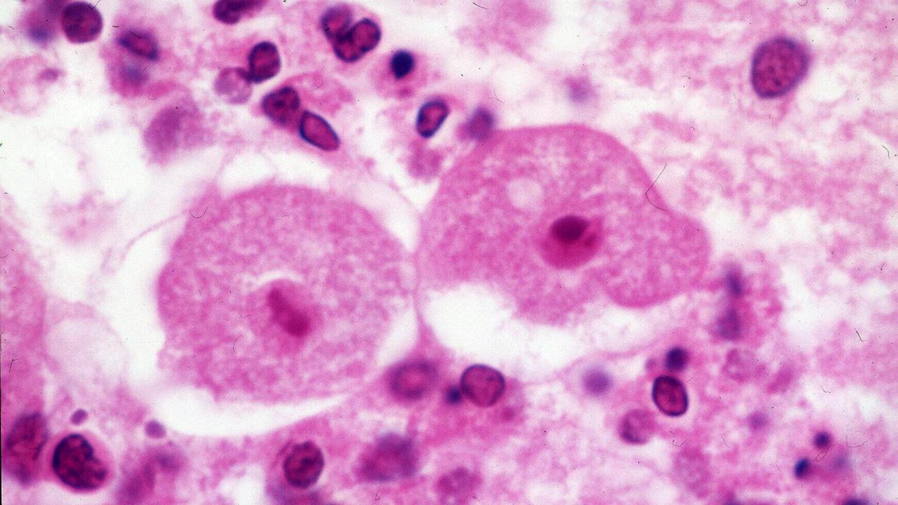 naegleria-fowleri-us-boy-13-battling-deadly-brain-eating-amoeba