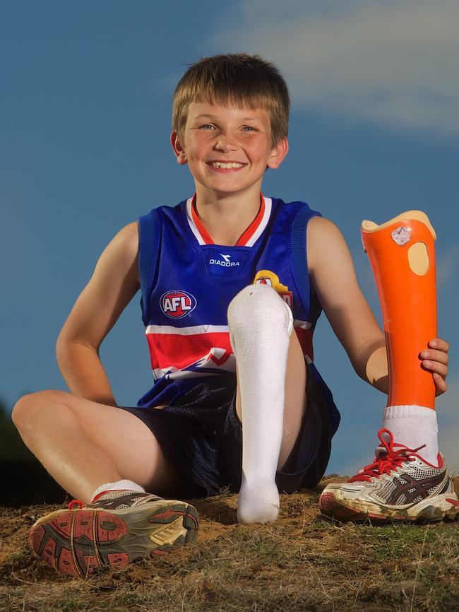 Jacob Mibus in 2012 after losing his foot after a mower accident. Picture: Rob Leeson