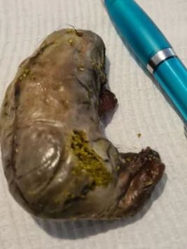 Suspected rat poison stuffed inside a sliced kidney, which was then stitched back up, was found by a dog on the Linear Park Trail at Dernancourt on Monday, August 31.