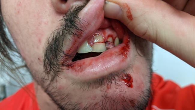 St George Illawarra Dragons winger Cody Ramsey broke two teeth in a collision with teammate Andrew McCullough in their loss to the Canberra Raiders